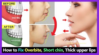 7 Steps How to Fix Overbite, small chin, big thick upper lip without braces naturally.