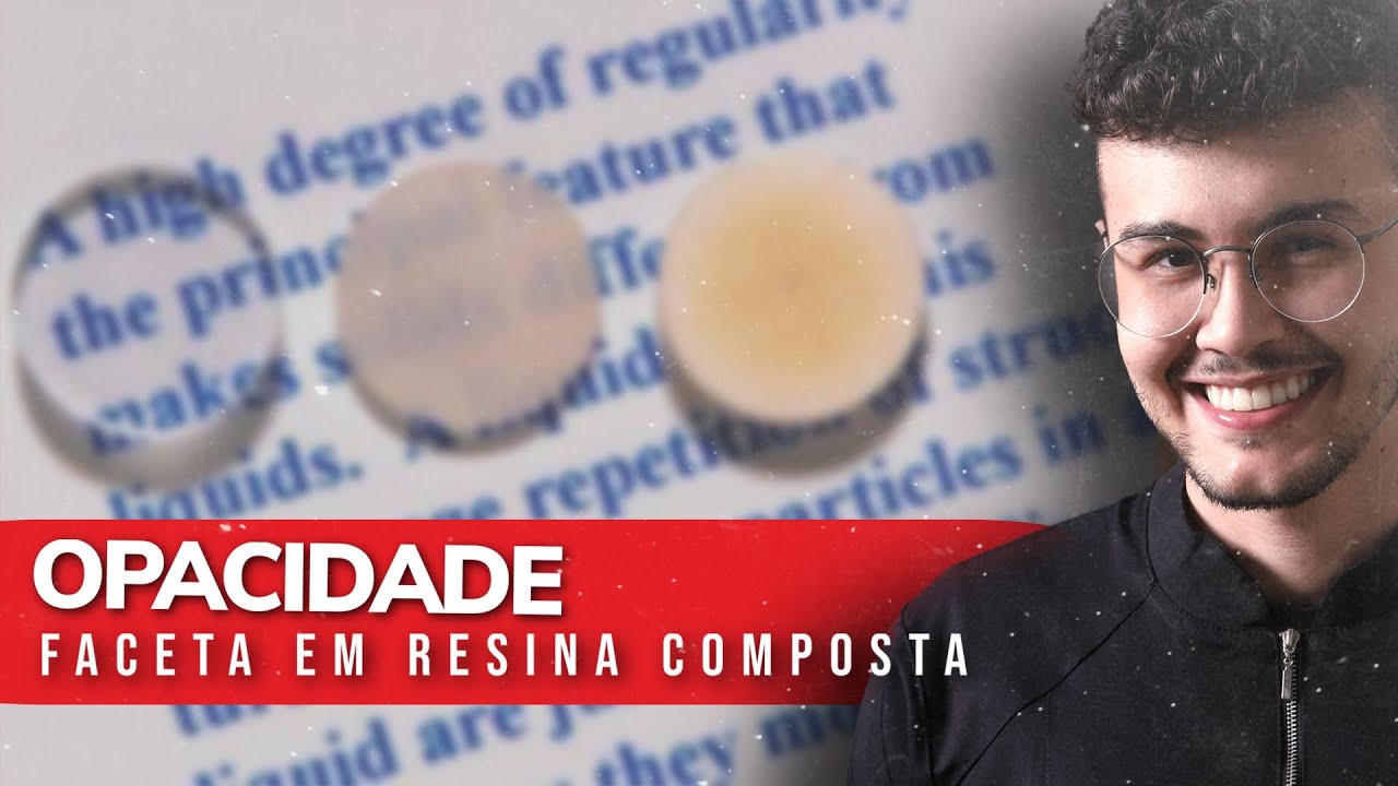 Opacidade de Resinas Compostas - Escolha para Facetas de Resina [RESUMÃO]