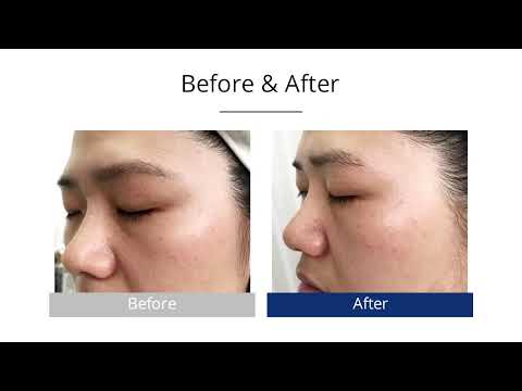 Hydrafacial Machine