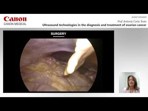 ISUOG 2020 Antonia Testa - Ultrasound Technologies in the diagnosis and treatment of ovarian cancer