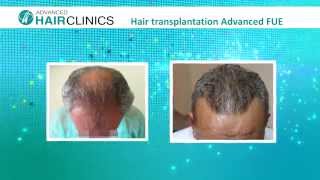 Hair Transplantation Results Video - Advanced Hair Clinics