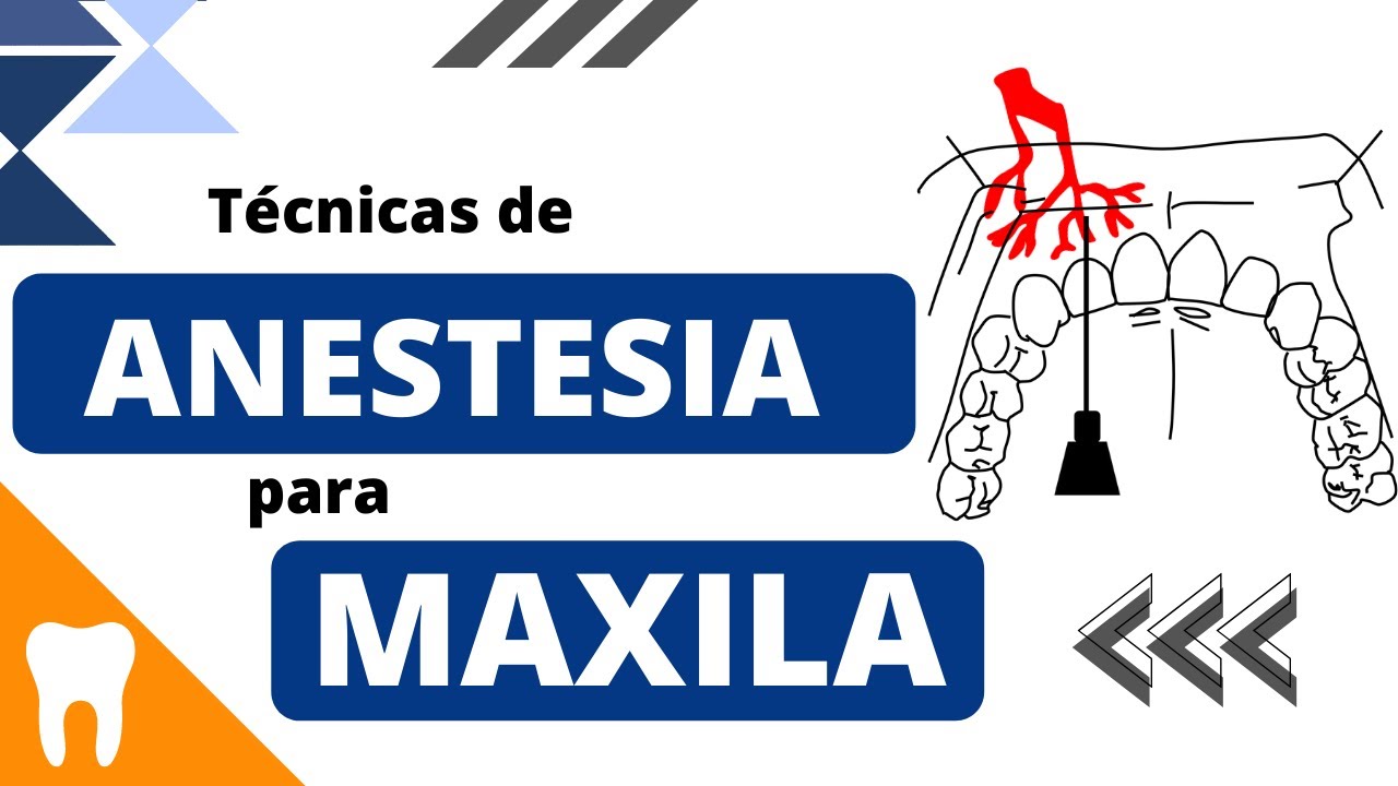 Entenda as TÉCNICAS ANESTÉSICAS PARA MAXILA