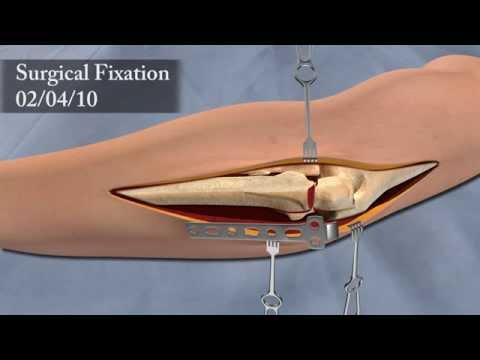 Orthopaedic - Techniques in Orthopaedic Surgery Video