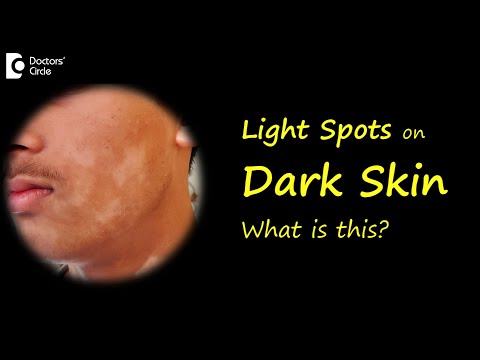 LIGHT SPOTS & PATCHES ON BROWN OR DARK SKIN? Causes & Treatment - Dr.Nischal K | Doctors' Circle