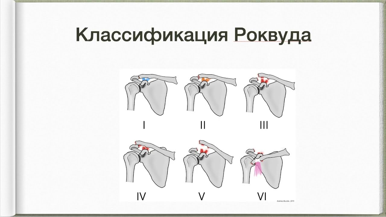 19. Повреждения лопатки, переломы и вывихи ключицы.