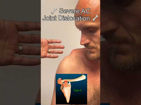 Severe AC Joint Dislocation! Explained By Orthopedic Surgeon #shorts #shoulder #surgeon