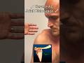 Severe AC Joint Dislocation! Explained By Orthopedic Surgeon #shorts #shoulder #surgeon