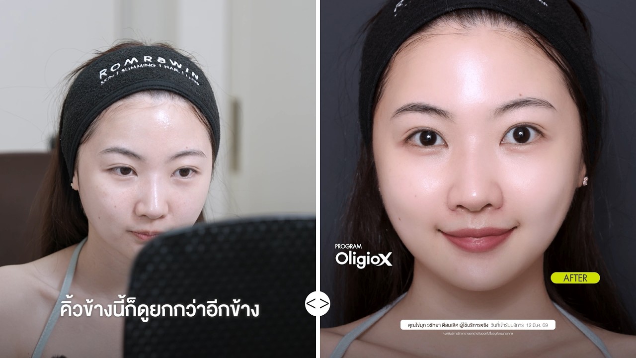รีวิวคุณไข่มุก BNK ทำโปรแกรมยกกระชับ Oligio ลดร่องแก้มและสลายไขมันสะสมบริเวณแก้มยุบไวทันใจที่รมย์รวินท์คลินิก