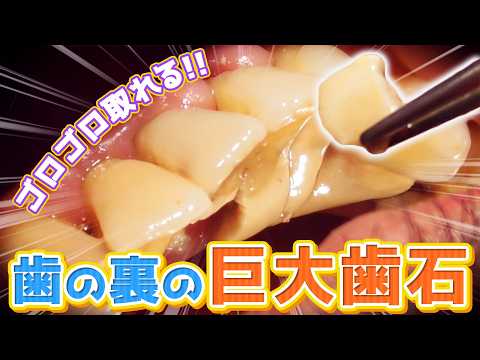 【歯石除去】ゴロゴロ取れる‼️歯の裏の巨大歯石‼️