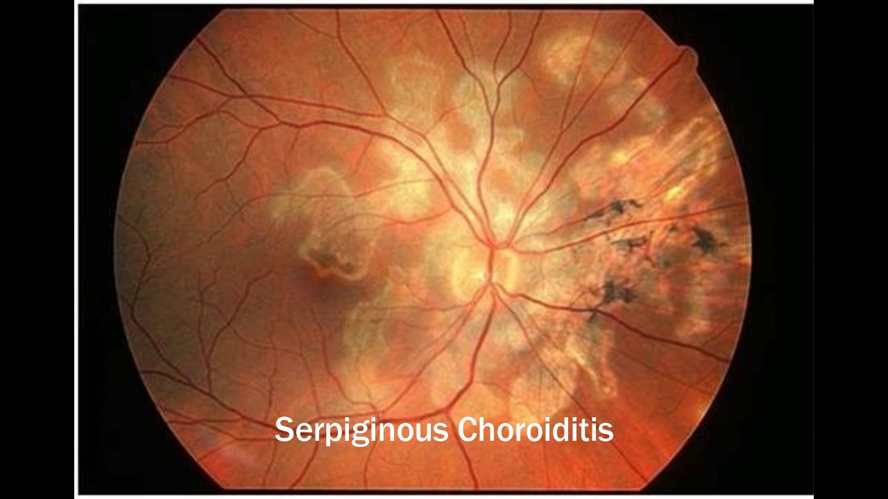White dot syndromes - An Introductory tutorial - YouTube