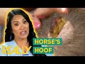 Dr Lee Removes A Horse S Hoof Like Bump From Patient S Head Dr Pimple Popper