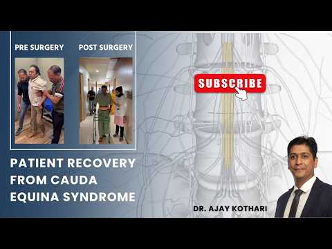 Patient Recovery from Cauda Equina Syndrome | Dr. Ajay Kothari