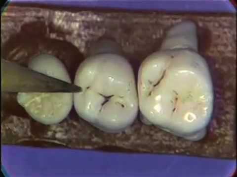Maxilliary Molars