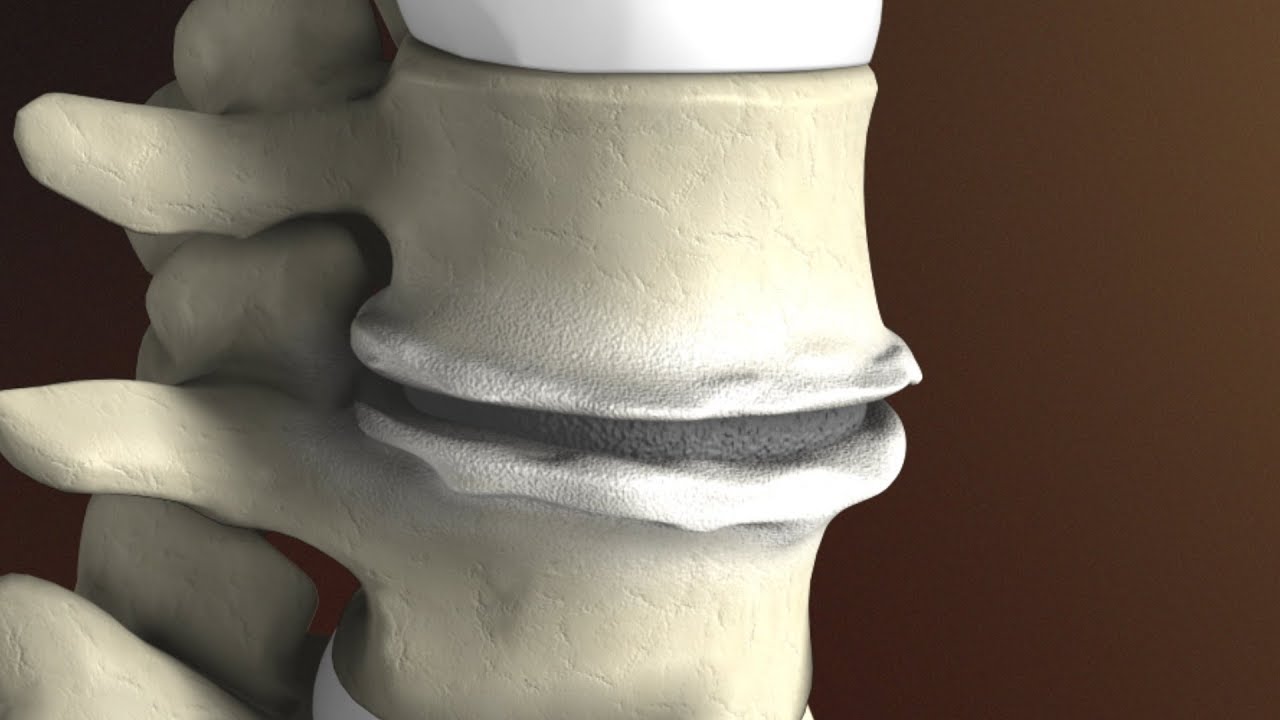 What is spondylosis in the lower back?