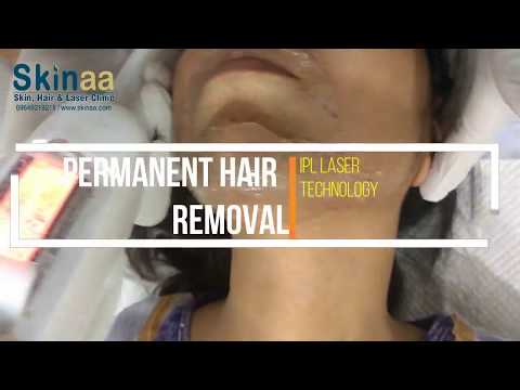 How IPL Laser Technology Removes Hairs Permanently | Skinaa Clinic, Jaipur
