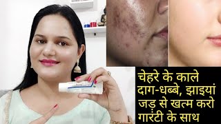 चेहरे के काले दाग-धब्बे, झाइयां, निशान, चेचक के दाग गारंटी के साथ जड़ से खत्म करो एक ही रात में |