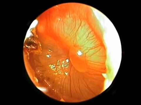 Otoscopic Signs of Acute Otitis Media | NEJM Video