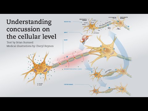 Champion: A gray matter