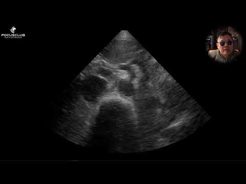 How to use POCUS to scan for the Abdominal Aorta?