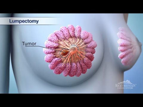 Lumpectomy and Mastectomy Animations