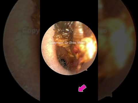 EAR WAX REMOVAL #Shorts #768