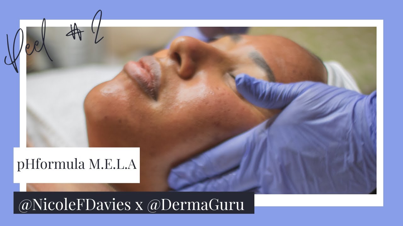pHFormula Advanced Resurfacing MELA Peel At The DermaGuru | Ep. #3 | Hyperpigmentation & Dark Spots