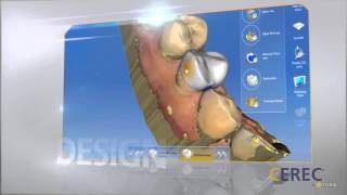 CEREC Technology: Get a New Crown In One Visit