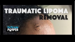 Removing a probable "traumatic lipoma" on the forehead