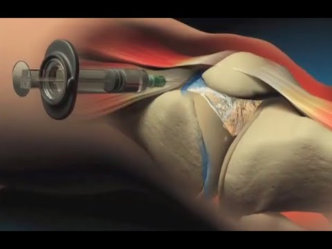 Spandilez della colonna vertebrale cervicale UHF fisioterapia congiunta che