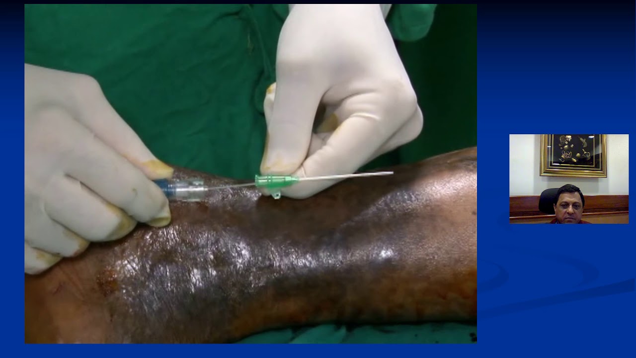 How to Close Perforator Veins Using Laser