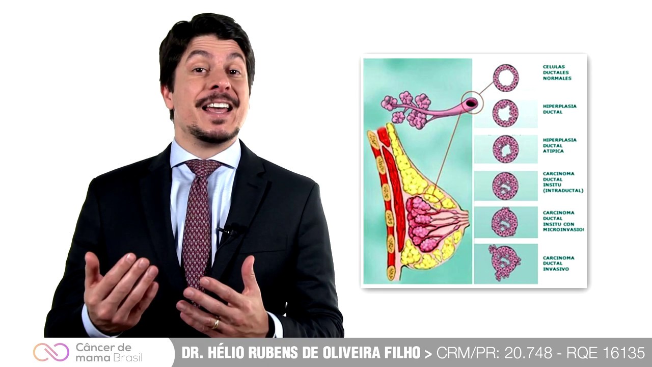 CARCINOMA DUCTAL INVASIVO.