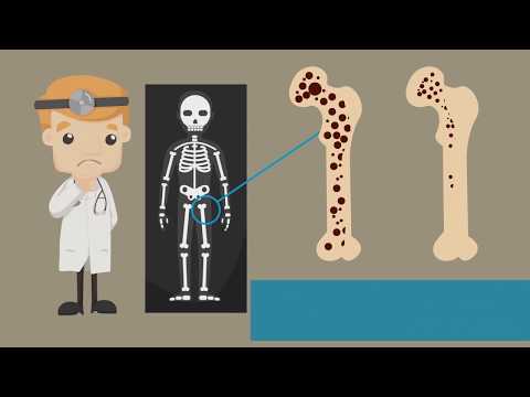 Osteoporosis