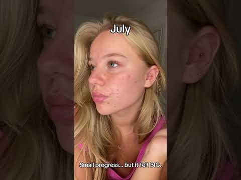 Acne is painful - healing takes time but you'll get there #skincare #beeftallow #viral #glowup #Acne