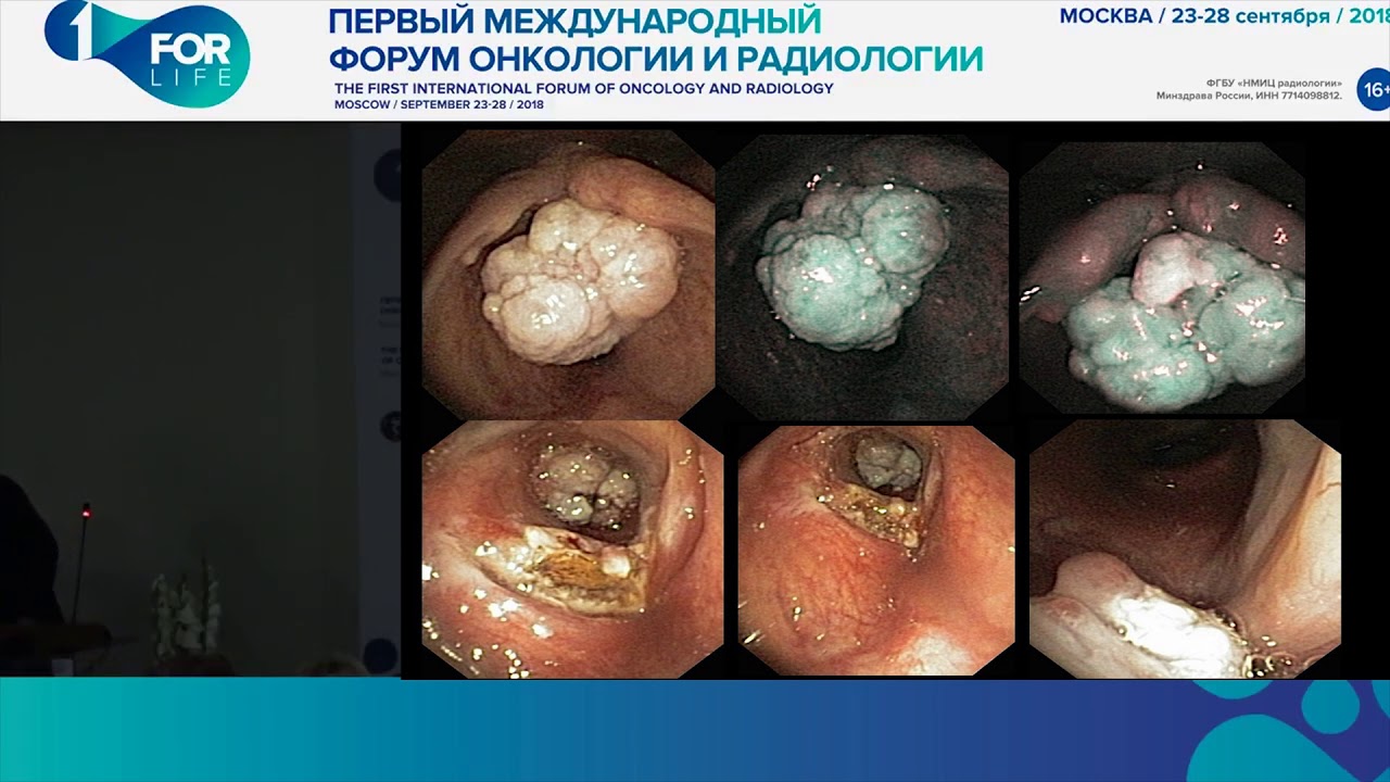 Эндоларингеальная хирургия доброкачественных опухолей гортани М Т Беков, Л Г Кожанов