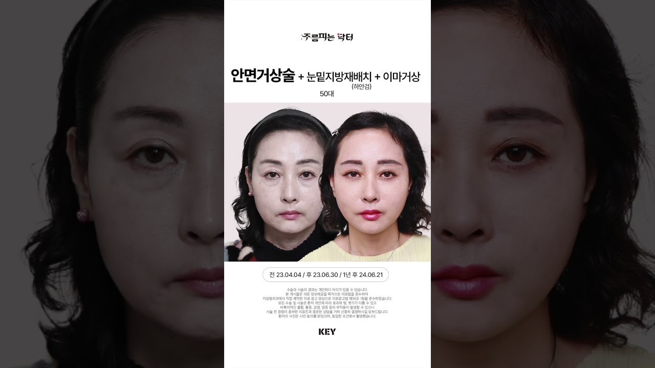 50대의 놀라운 변화 / 눈밑 안면 이마