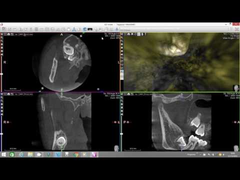 X-Mind Trium Endodontic Virtual Endoscope in AIS