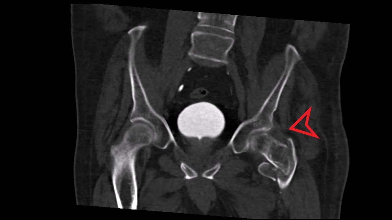 Pelvis CT: Intertrochanteric Hip Fracture