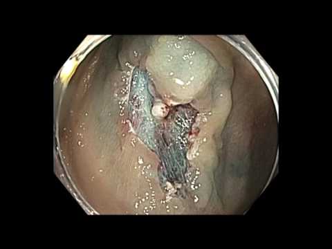 Colonoscopia - colon ascendente - lesión plana sutil - adenoma serrado sésil