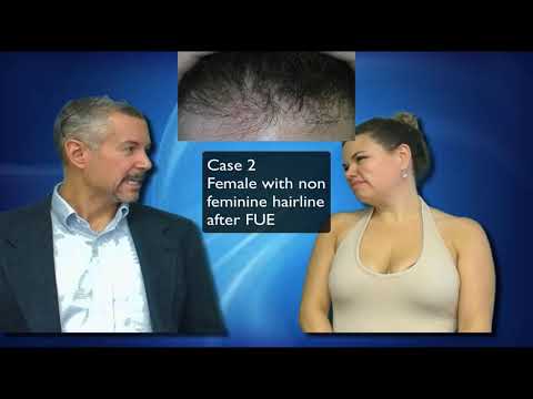 Watch out for these FUE SCAMS! Dr. Lindsey in DC shares 3 common problems | Washington | McLean thumbnail