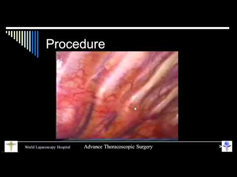 Thoracoscopic Sympathectomy