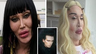 Pete Burns Admits he is had Over 300 Operations to Fix Botched Surgery