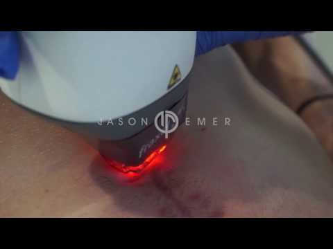 Fraxel Laser | Surgical Scar Revision and Repair | Beverly Hills California