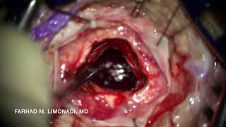 Brain hemorrhage:  Surgical management of spontaneous brain hemorrhage resulting in coma