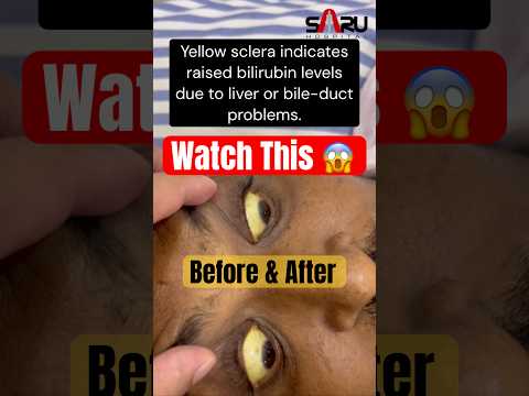Jaundice Before and After Treatment | Yellow Eyes Turn White | Causes & Recovery | Dr Sachin Deore