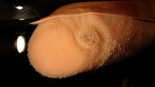 I should have removed this wart a long time ago!