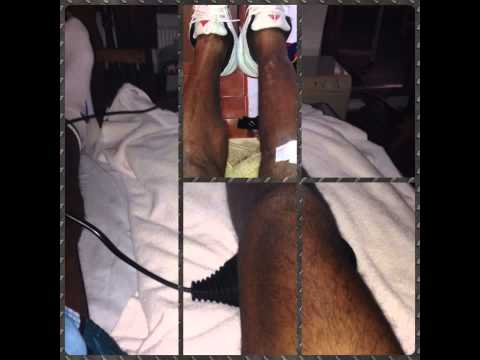 Lesion de fractura tibia y perone