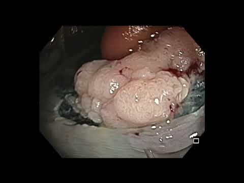 Colonoscopy: Large IC valve/ascending colon EMR - 101 min