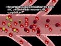 Disseminated Intravascular Coagulation DIC And Placental Abruption By Cal Shipley M D