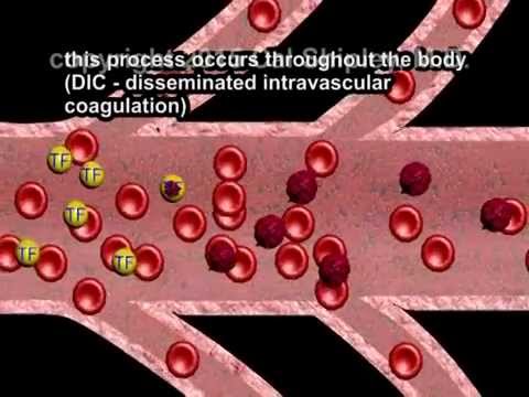 Disseminated Intravascular Coagulation (DIC) and Placental Abruption by Cal Shipley, M.D.