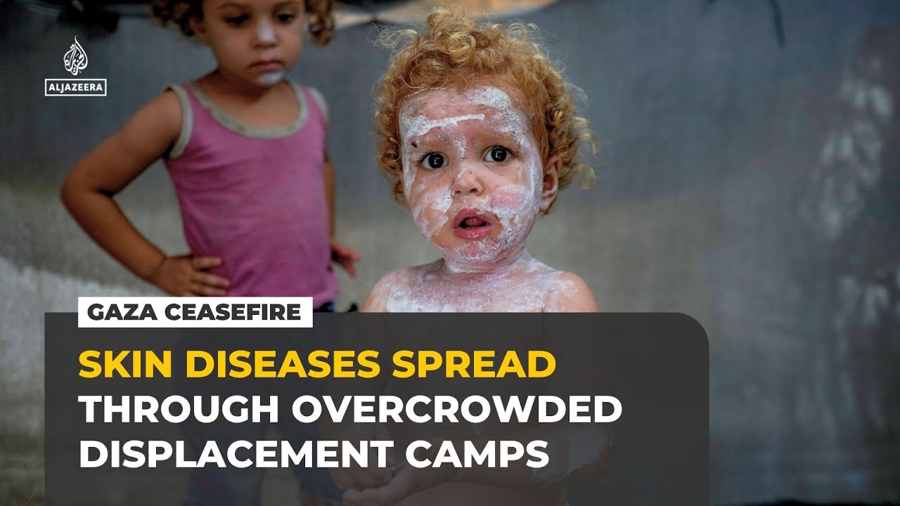 Skin diseases surge in Gaza’s overcrowded displacement camps